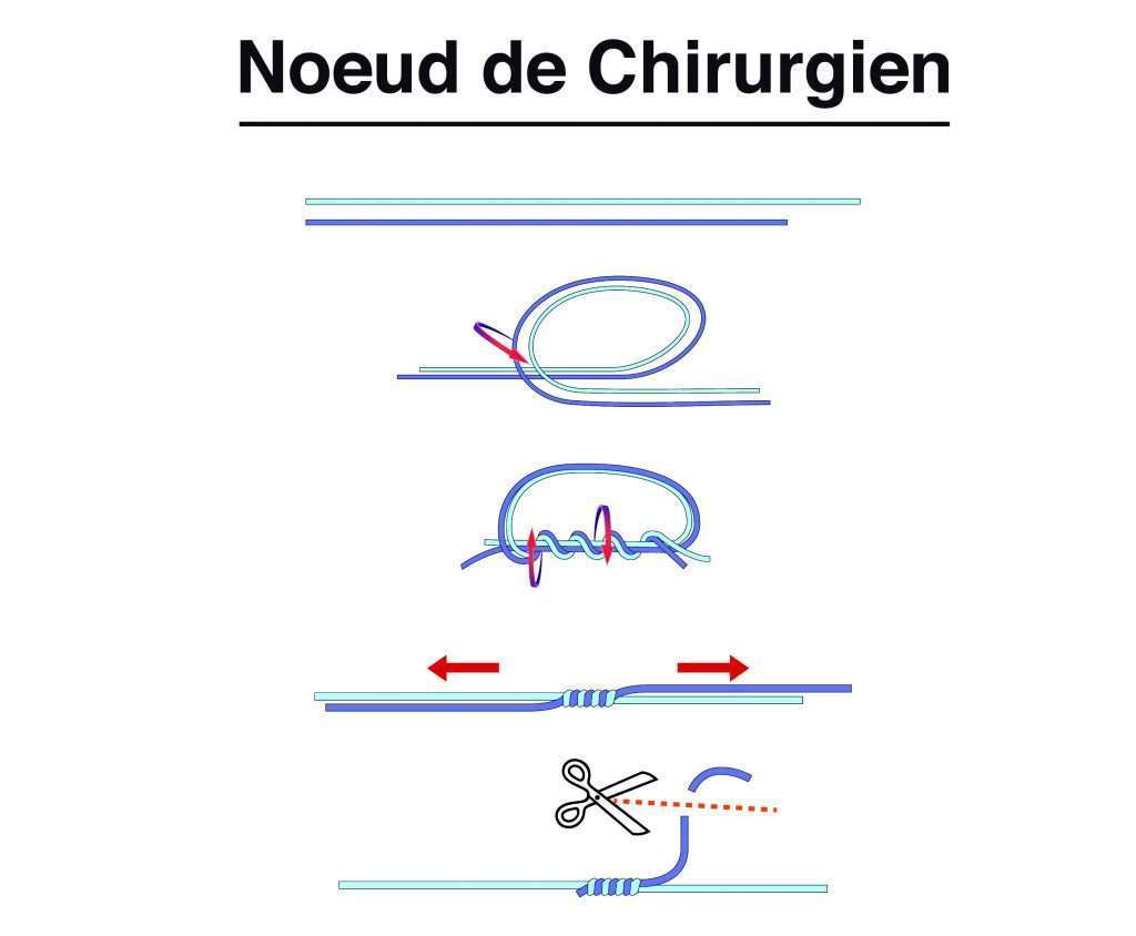 Noeud de Chirurgien