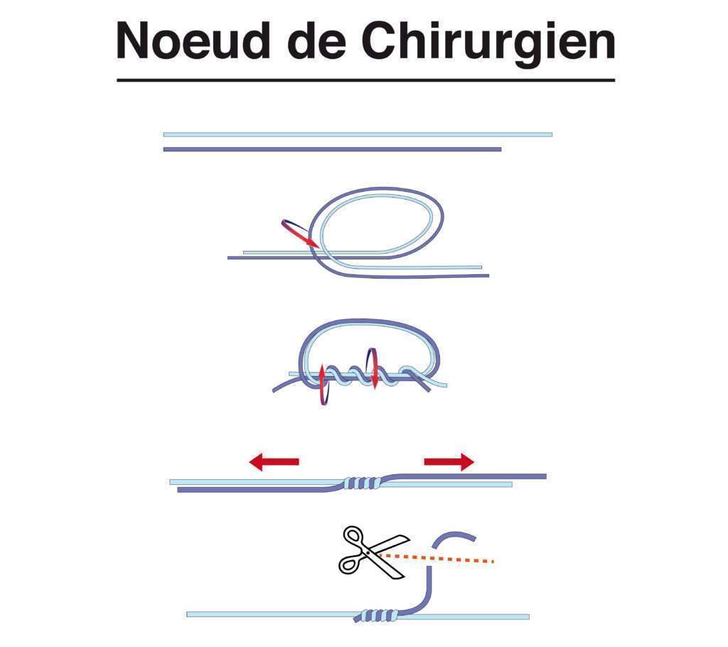 Nœud de chirurgien